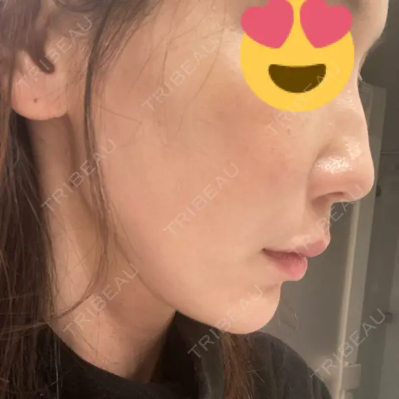 糸リフト / 脂肪吸引（顔） / ボトックス（エラ・小顔） / ヒアルロン酸注入（頬） Tokyo Tensei Clinic 新宿院 DAY 54 メイン用