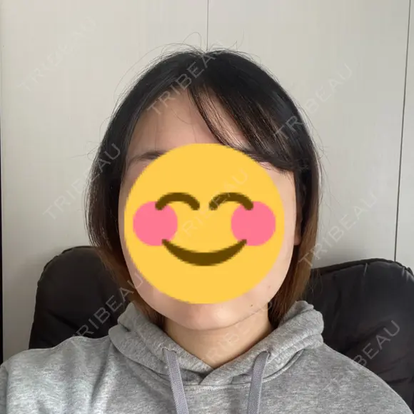 骨削り（エラ） / 脂肪吸引（顔） id（アイディ）美容外科 DAY 10 メイン用