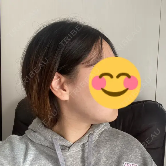 骨削り（エラ） / 脂肪吸引（顔） id（アイディ）美容外科 DAY 10 メイン用