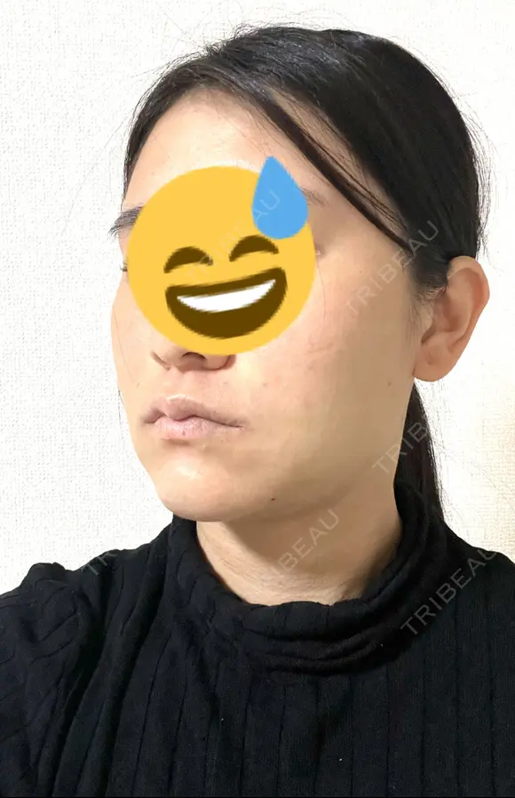 糸リフト / 脂肪吸引注射（顔） / 脂肪注入（輪郭） イテウォンビューティークリニック 名古屋栄院 DAY 4 メイン用
