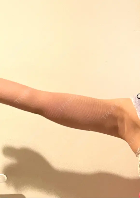 脂肪吸引（二の腕） くさのたろうクリニック DAY 37 メイン用