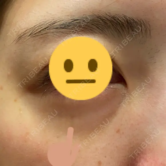 脂肪溶解注射（顔） / シワ取りボトックス / ボトックス（眉間） / ボトックス（目尻） TCB東京中央美容外科 梅田茶屋町院 AFTER メイン用