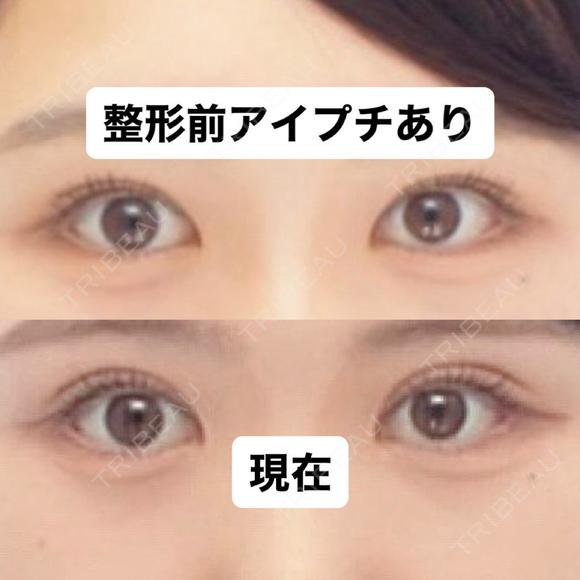二重切開 つだ美容外科クリニック DAY 112 メイン用