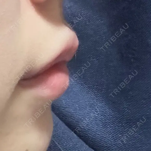 ヒアルロン酸注入（唇） 銀座美容外科クリニック 新宿院 DAY 0 メイン用