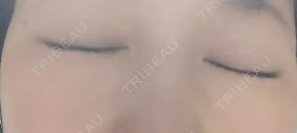 ボトックス（眉間） 湘南美容クリニック 本厚木院 DAY 17 メイン用