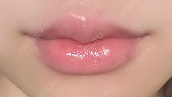 ヒアルロン酸注入（唇） 銀座美容外科クリニック 新宿院 DAY 1 メイン用