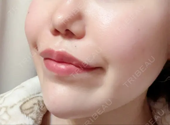 ボトックス（エラ・小顔） / ヒアルロン酸注入（頬） 高崎TAクリニック DAY 18 メイン用