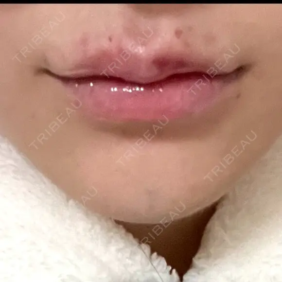 ボトックス（あご） / ヒアルロン酸注入（唇） / ボトックス（口角） ルラ美容クリニック 大阪本院 DAY 2 メイン用