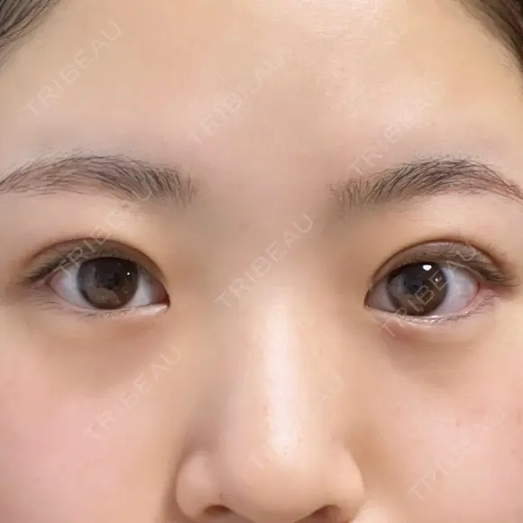 目頭切開 東京エビスクリニック DAY 54 メイン用