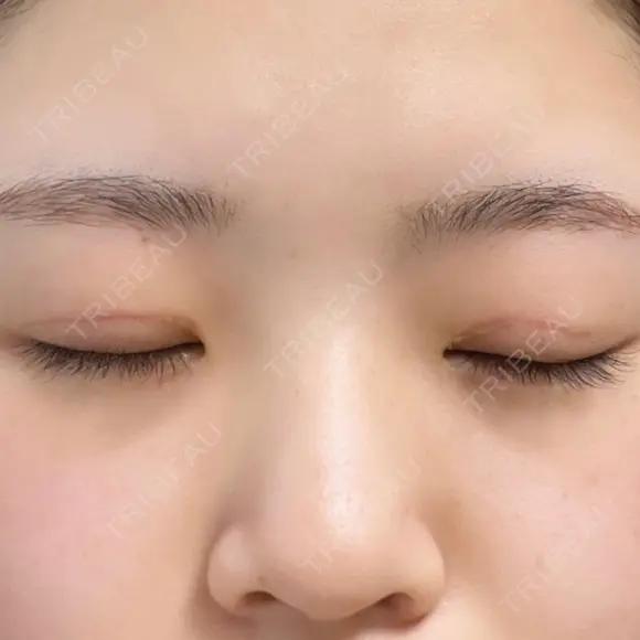 目頭切開 東京エビスクリニック DAY 54 メイン用