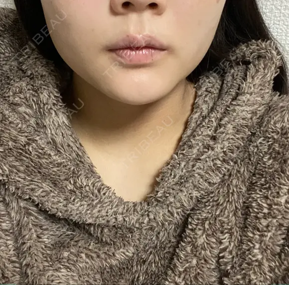 ボトックス（エラ・小顔） TCB東京中央美容外科 京都駅前院 AFTER メイン用