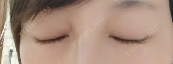 ボトックス（眉間） 湘南美容クリニック 本厚木院 DAY 21 メイン用