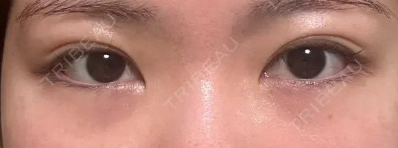 クマ治療 湘南美容クリニック 仙台院 DAY 7 メイン用