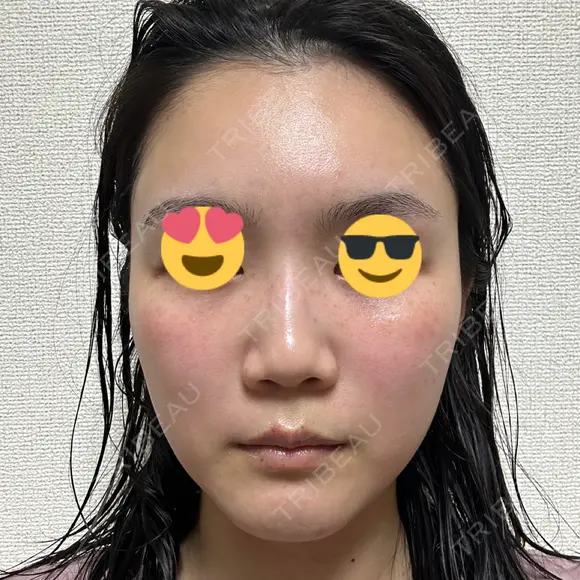 ハイフ（顔） / イオン導入 湘南美容クリニック 新宿南口院 DAY 8 メイン用