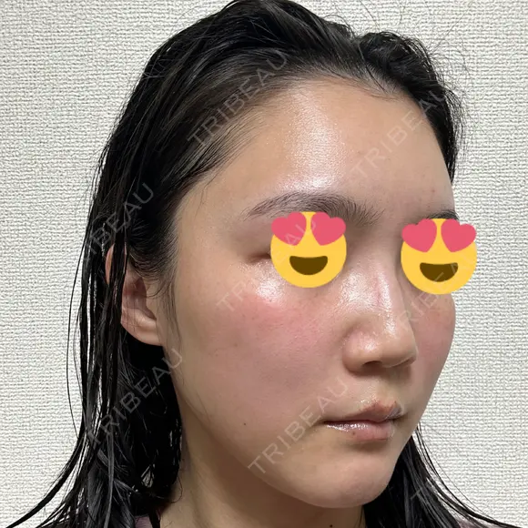 ハイフ（顔） / イオン導入 湘南美容クリニック 新宿南口院 DAY 8 メイン用