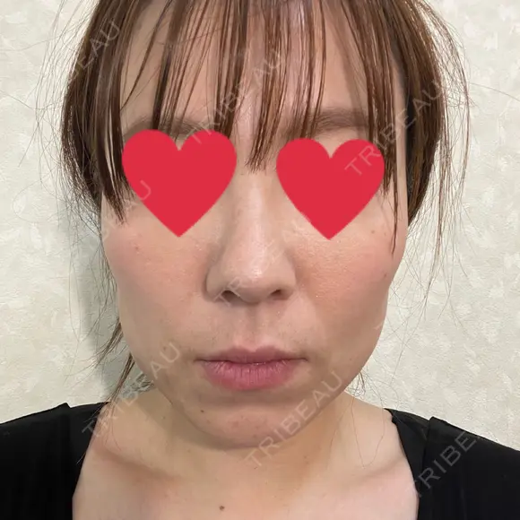 脂肪吸引（顔） / 脂肪吸引（お腹） / 豊胸（脂肪注入） / 脂肪注入（肌） / 乳頭縮小 / 脂肪吸引（腰） / ボトックス（エラ・小顔） Mods Clinic（モッズクリニック） 大阪院 DAY 28 メイン用