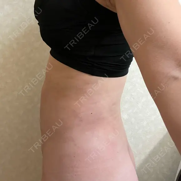 脂肪吸引（顔） / 脂肪吸引（お腹） / 豊胸（脂肪注入） / 脂肪注入（肌） / 乳頭縮小 / 脂肪吸引（腰） / ボトックス（エラ・小顔） Mods Clinic（モッズクリニック） 大阪院 DAY 28 メイン用