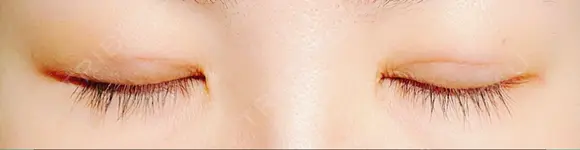 二重埋没 水の森美容クリニック 東京銀座院 DAY 6 メイン用