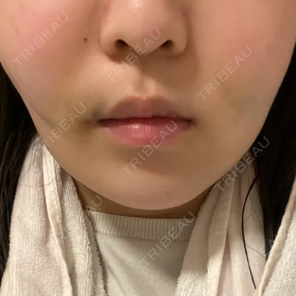 糸リフト / バッカルファット除去 / 脂肪吸引（顔） EMMA CLINIC（エマクリニック） DAY 3 メイン用