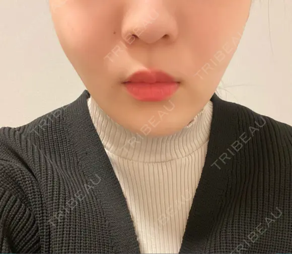 糸リフト / バッカルファット除去 / 脂肪吸引（顔） EMMA CLINIC（エマクリニック） DAY 30 メイン用