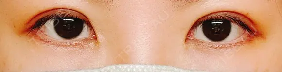 二重埋没 水の森美容クリニック 東京銀座院 DAY 7 メイン用