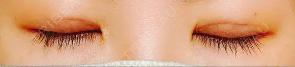 二重埋没 水の森美容クリニック 東京銀座院 DAY 7 メイン用