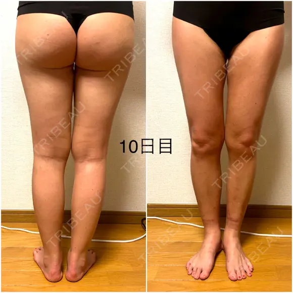脂肪吸引（脚） / 豊胸（脂肪注入） GAYA body design clinic DAY 10 メイン用