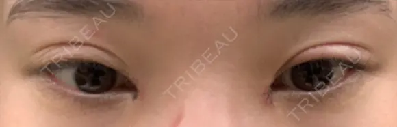 目頭切開 ziz CLINIC DAY 10 メイン用