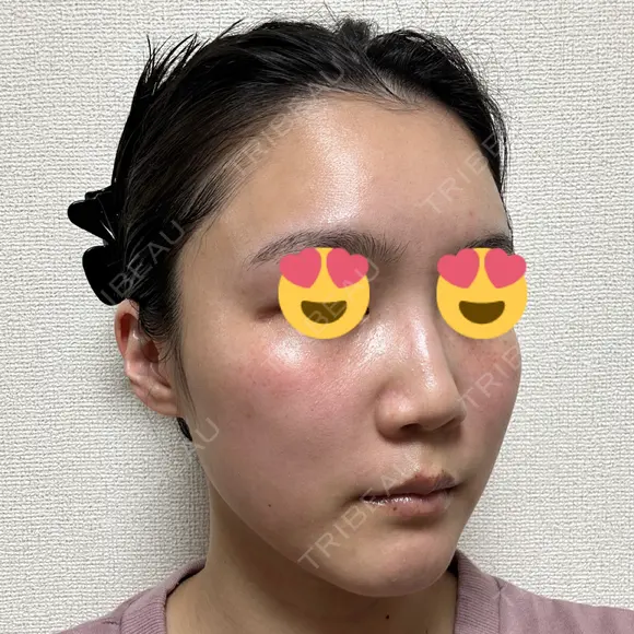 ハイフ（顔） / イオン導入 湘南美容クリニック 新宿南口院 DAY 10 メイン用