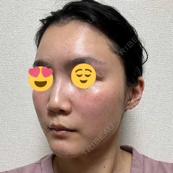 ハイフ（顔） / イオン導入 湘南美容クリニック 新宿南口院 DAY 10 メイン用