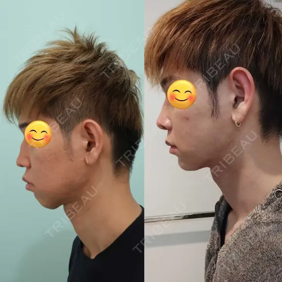 糸リフト / 脂肪吸引（顔） / ジョールファット除去 / 医療痩身（顔） / インディバ（顔） WOM CLINIC GINZA （ワム クリニック ギンザ） DAY 60 メイン用