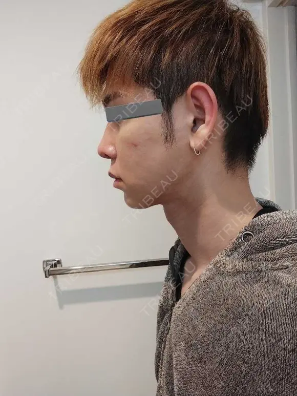 糸リフト / 脂肪吸引（顔） / ジョールファット除去 / 医療痩身（顔） / インディバ（顔） WOM CLINIC GINZA （ワム クリニック ギンザ） DAY 60 メイン用