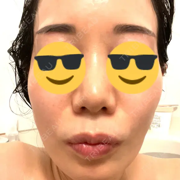 ハイフ（顔） / ピコレーザートーニング（美白・肝斑） / フラクショナルレーザー（毛穴・ニキビ跡） TRUE DESIGN CLINIC AFTER メイン用