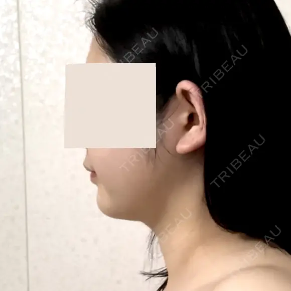 糸リフト / 脂肪吸引（顔） Casa de GRACIA GINZA 【カーサデグラシアギンザ】 DAY 93 メイン用