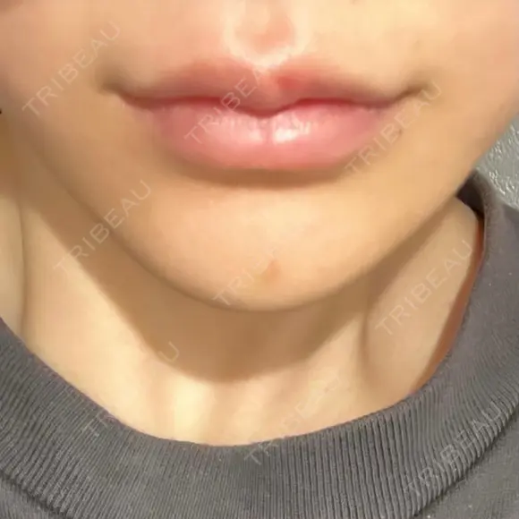 ボトックス（あご） / ヒアルロン酸注入（唇） / ボトックス（口角） ルラ美容クリニック 大阪本院 DAY 8 メイン用