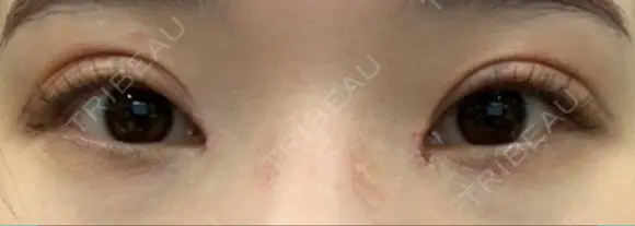 目頭切開 ziz CLINIC DAY 12 メイン用