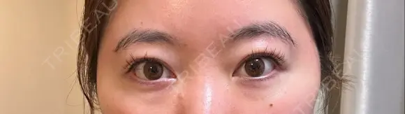 二重埋没 / 上まぶたの脂肪取り アリエル美容クリニック 郡山院 AFTER メイン用