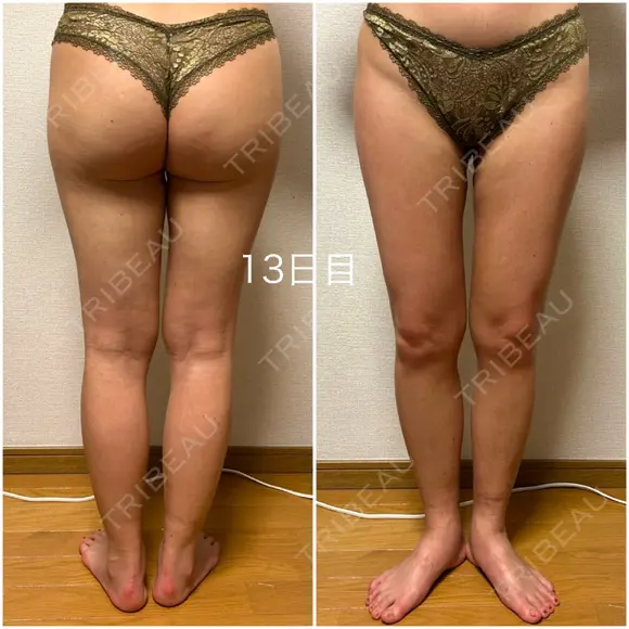 脂肪吸引（脚） / 豊胸（脂肪注入） GAYA body design clinic DAY 13 メイン用