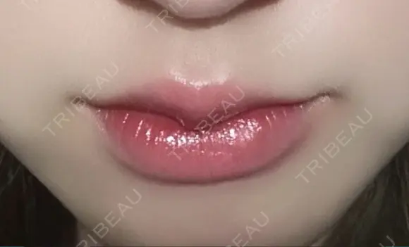 ヒアルロン酸注入（唇） 銀座美容外科クリニック 新宿院 AFTER メイン用