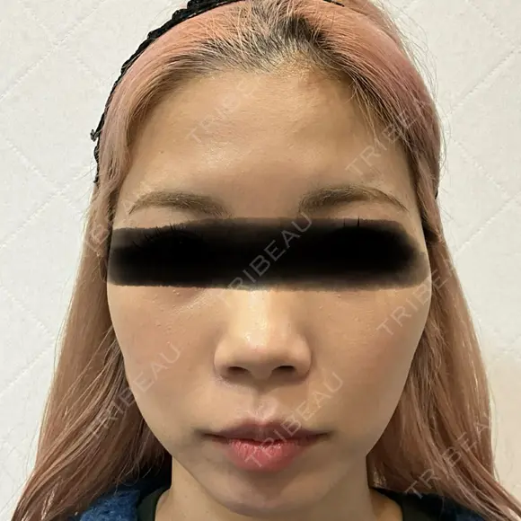 ボトックス（あご） / ボトックス（エラ・小顔） / ボトックス（口角） / ボトックス（眉間） / ボトックス（額） M'sクリニック【エムズクリニック】 AFTER メイン用