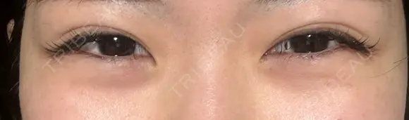 クマ治療 湘南美容クリニック 仙台院 DAY 14 メイン用