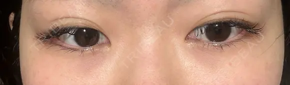 クマ治療 湘南美容クリニック 仙台院 DAY 14 メイン用