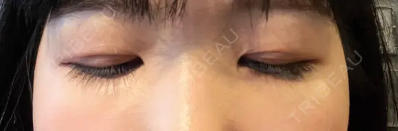 スネコス スマートスキンクリニック 神保町院 DAY 1 メイン用