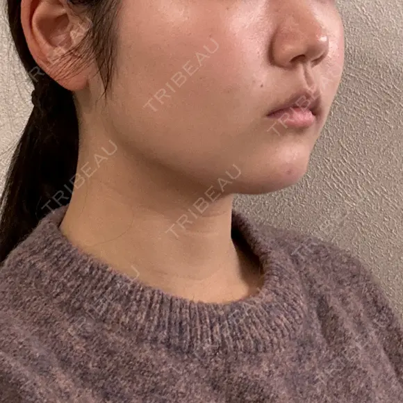 バッカルファット除去 / 脂肪吸引（顔） 湘南美容クリニック 京都院 DAY 167 メイン用