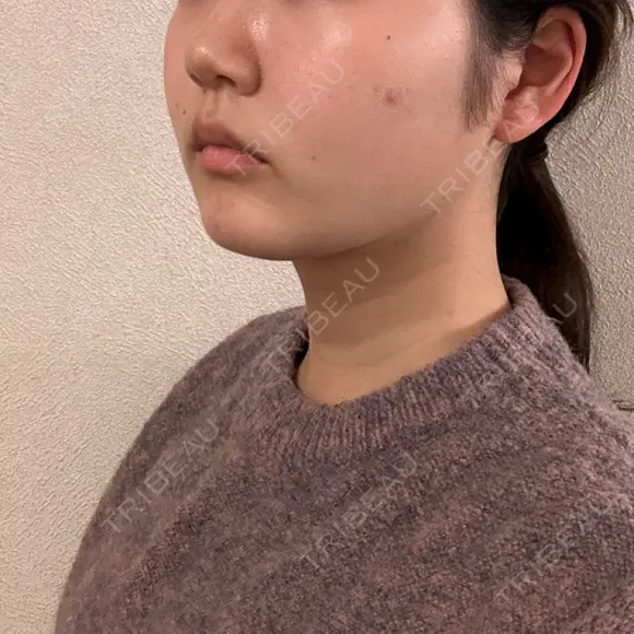 バッカルファット除去 / 脂肪吸引（顔） 湘南美容クリニック 京都院 DAY 167 メイン用