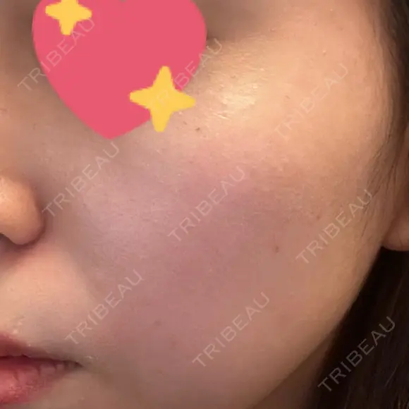 ルメッカ BIANCA表参道 DAY 5 メイン用