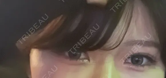 二重埋没 湘南美容クリニック 仙台院 AFTER メイン用