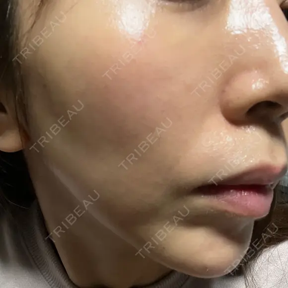 肌ヒアルロン酸注入（たるみ・シワ改善） BAO CLINIC 心斎橋院 DAY 40 メイン用