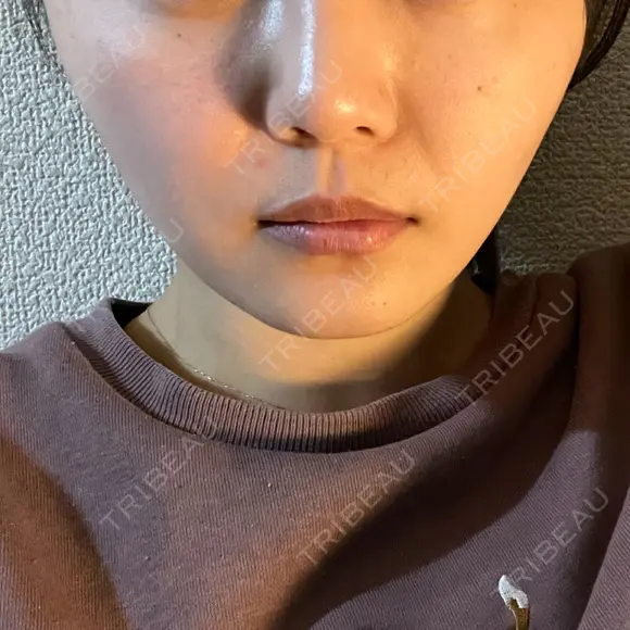 糸リフト 仙台TAクリニック AFTER メイン用