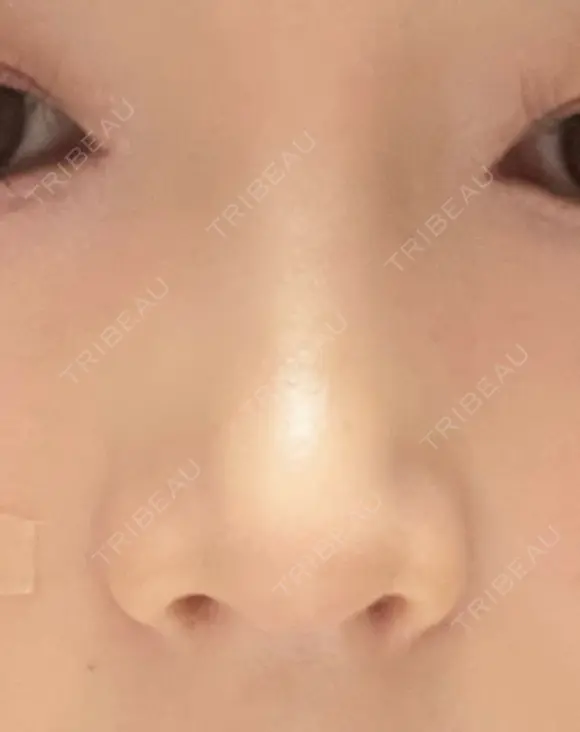 鼻尖形成（切開） / 軟骨移植 / 鼻修正 / 鼻柱下降・鼻唇角形成（猫手術） 東京シンデレラ美容外科 池袋院 DAY 17 メイン用